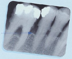 Hvor fremskreden parodontitis er, kan kun ses på røntgenbilleder.